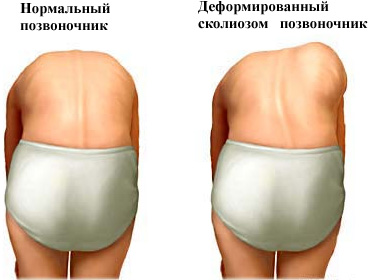 scoliosis54
