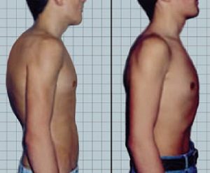 thoracicscoliosis