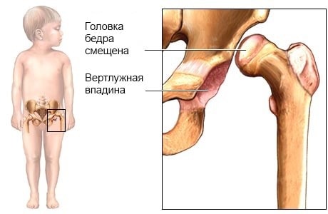 Локализация костей ТБС у ребенка с дисплазией.